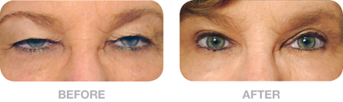 Image of woman with sagging Eyelids with Before Text and Image Next to it of Fixed Eyelids that Don't Sag Anymore with After Text